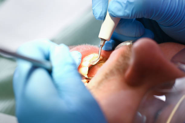 Best Emergency Tooth Extraction in Buena Vista, MI
